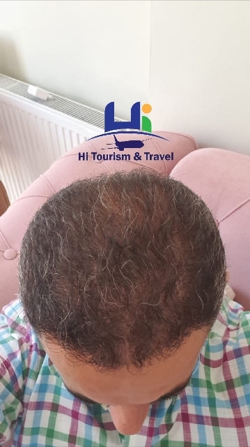 Sapphire Fue Hair Transplant Technique